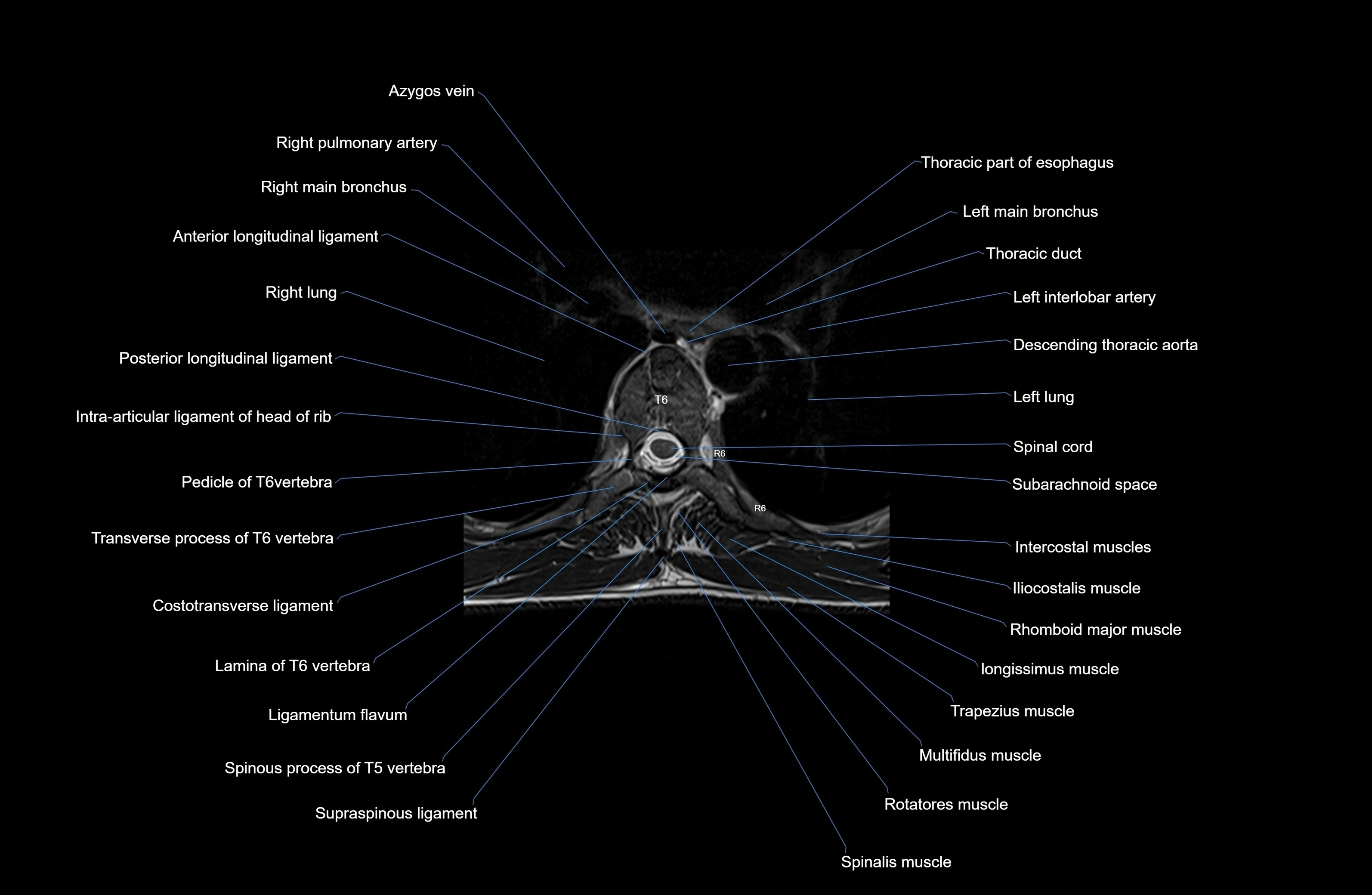 MRI thoracic spine axial  cross sectional anatomy 3T radiology  image-img-00001-00038.webp